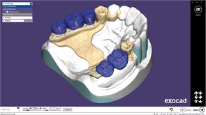 Модуль Exocad Partial Framework Module. Модуль создания бюгелей PartialFrameworkModule