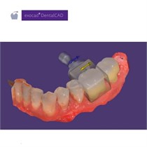 Exocad Modul Nesting (incl. In-CAD Nesting) 265222