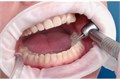 OptraGate  Regular стандартные, 1шт.,  Ivoclar. 123191086 - фото 445488