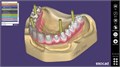 Модуль Exocad Implant module. Имплант модуль Implantmodule - фото 476025